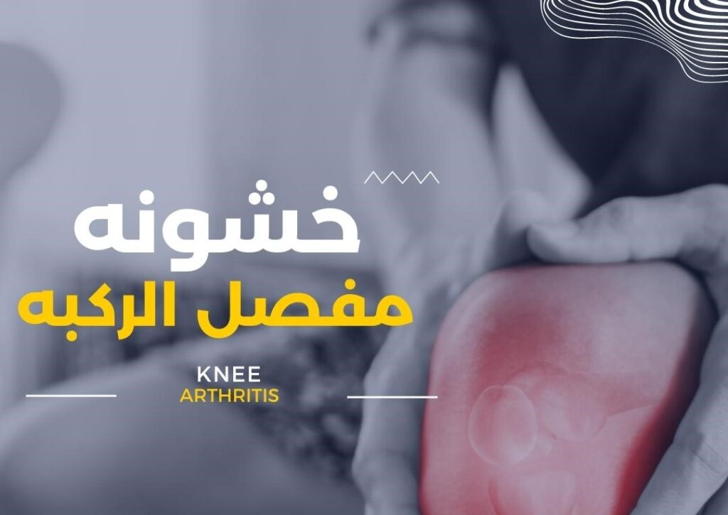 علاج خشونة مفصل الركبة في الكويت – جلسات علاج طبيعي لتقليل الألم وتحسين الحركة knee arthritis خشونة مفصل الركبة
